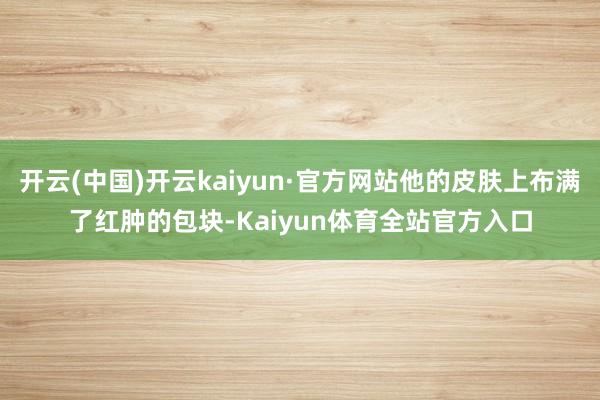 开云(中国)开云kaiyun·官方网站他的皮肤上布满了红肿的包块-Kaiyun体育全站官方入口